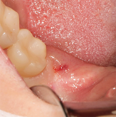 Das Foto zeigt ein entzündetes Zahnfleisch mit einem Weisheitszahn darunter.