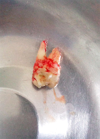 Photograph of a remote wisdom tooth in the cuspidor