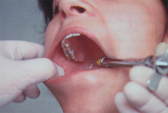 Lokalanästhesie durch Injektion in das Zahnfleisch