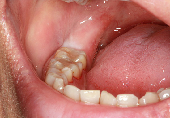 Caso clínico: o dente do siso ainda não entrou em erupção e está na gengiva.