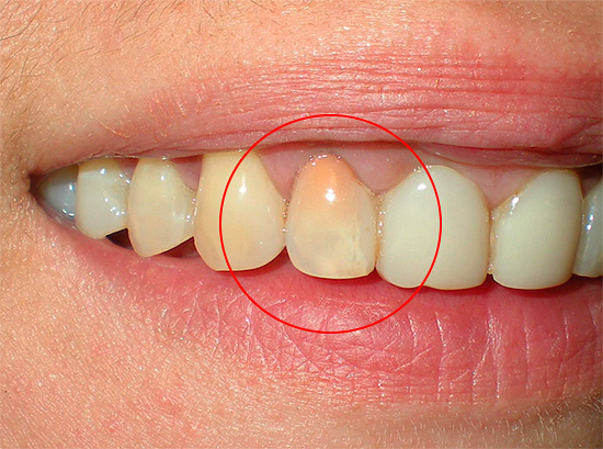 Ροζ δόντι μετά από επεξεργασία κονδυλίτιδας με τη χρήση μεθόδου ρεσορκίνης-φορμαλδεΰδης.