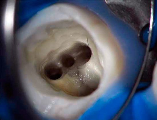 En el tratamiento de la pulpitis, es muy importante una limpieza de alta calidad de los canales dentales a partir de residuos de pulpa e infecciones.
