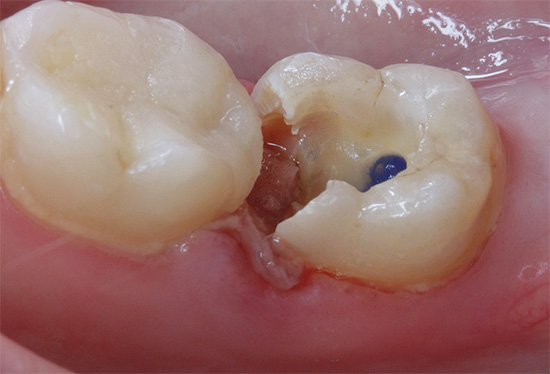 Voici comment se présente la dent au début du traitement: un matériau dévitalisant est visible dans la bouche du canal radiculaire.