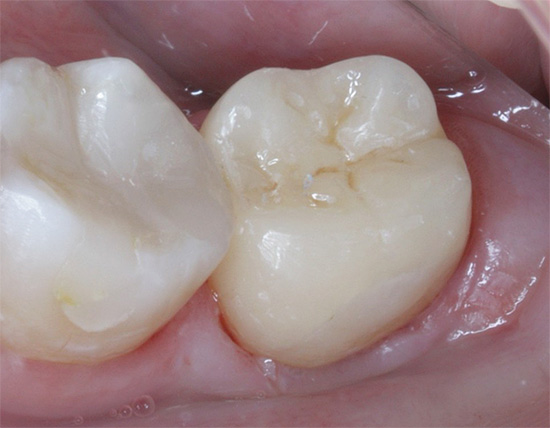 Et cela ressemble à la même dent après le traitement.