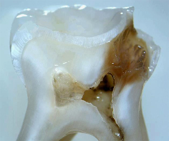 À la coupe, on peut voir que la cavité carieuse s'est approchée de la chambre pulpaire de la dent.