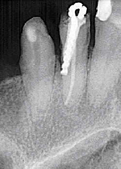 Une radiographie montre un exemple de perforation de la racine de la dent.