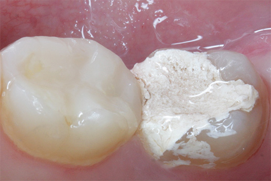 La fotografía muestra el llamado arsénico en el diente, un relleno temporal para matar el nervio.