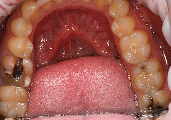 Bilden visar en tand med en djup karisk kavitet - i sådana fall kan sköljning ibland verkligen effektivt lindra smärta.