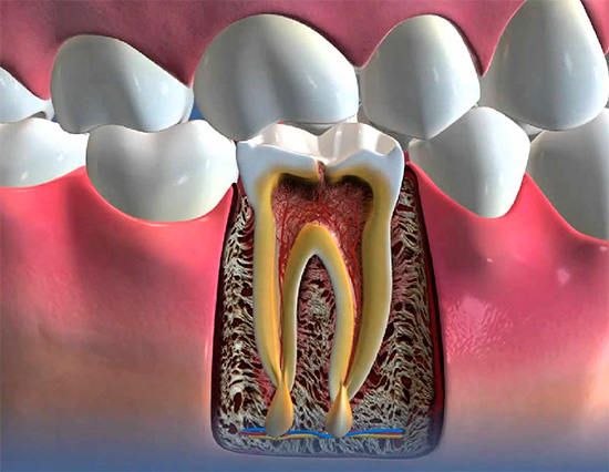 L'immagine mostra un esempio di parodontite - infiammazione purulenta sulla radice del dente.