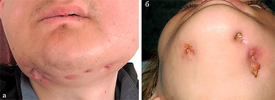 और यह तस्वीर odontogenic osteomyelitis के प्रभावों का एक उदाहरण दिखाती है।
