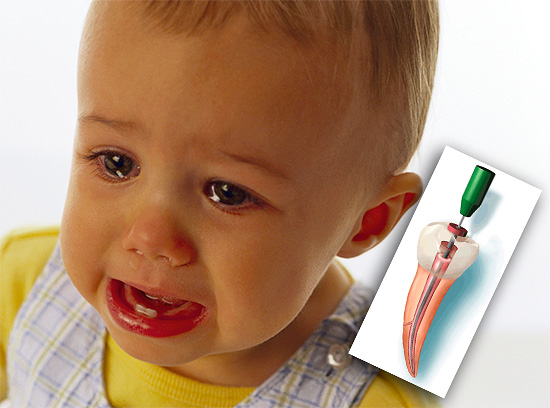 Помислете за основните подходи за лечение на пулпит на млечните зъби в детската стоматология ...