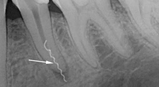 Une radiographie montre un exemple d'instrument brisé au niveau du canal radiculaire d'une dent.