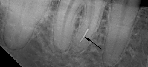 Des fragments de l'instrument dans le canal de la dent peuvent par la suite entraîner des complications ...