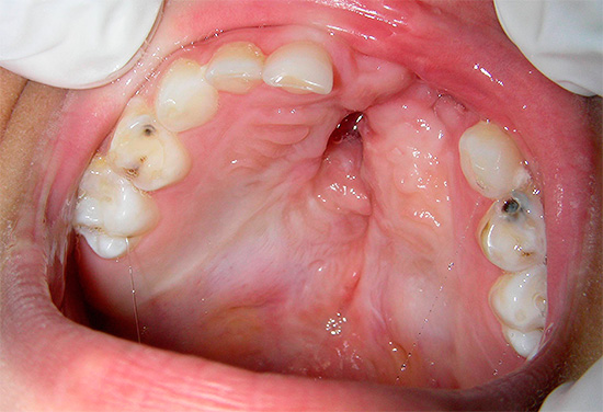La fotografía muestra una cavidad cariosa profunda en el diente de leche: a través de ella, las bacterias llegan fácilmente a la cámara pulpar.