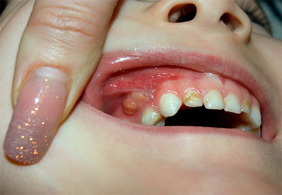 Поток върху венците на дете