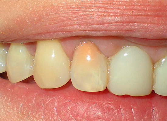 След лечение с пулпит, методът на резорцин-формалин на зъба става розов или дори червеникав.