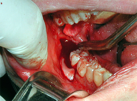 La escisión de la capucha gingival no siempre ayuda a resolver el problema de la supuración en las encías ...
