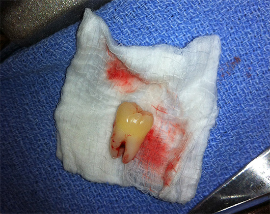 Si se extrae un diente irritante de las encías a tiempo mediante una cirugía, esto evitará muchos problemas en el futuro.