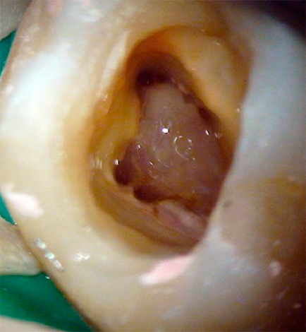 Пълното отстраняване на възпаления пулп от кореновите канали позволява на зъба да се отърве от източника на инфекция.