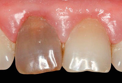 Así es como se ve el diente después de un tiempo después del tratamiento de la pulpitis con el uso de pasta de resorcinol-formalina.