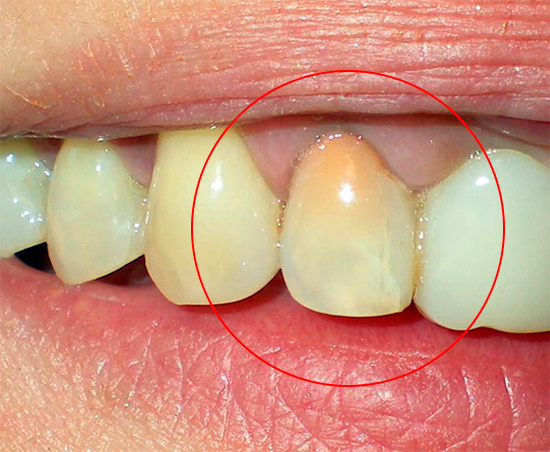 Друг пример за зъб, третиран с метода на резорцин-формалин за мумифицирането на целулозата.