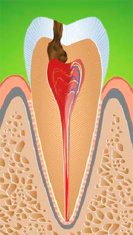 En la pulpitis fibrosa crónica, hay un reemplazo gradual de las fibras nerviosas por el tejido conectivo, lo que conduce a una disminución de la sensibilidad de la pulpa a diversos estímulos.