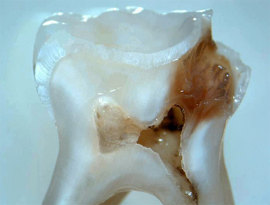 Un diente cortado con una cavidad cariosa profunda que tiene una comunicación a través de la cámara pulpar.
