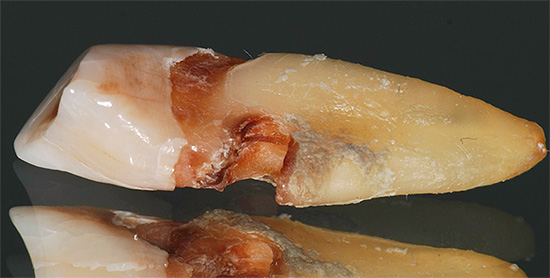 La foto muestra una cavidad cariosa profunda en la raíz del diente.