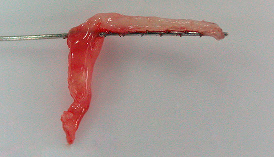 Así es como se ve la pulpa extraída de un diente.