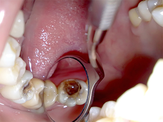 Nos presentan las peculiaridades de la pulpitis gangrenosa crónica: ¿cuál es el peligro de necrosis de la pulpa dentro de los conductos radiculares de un diente?