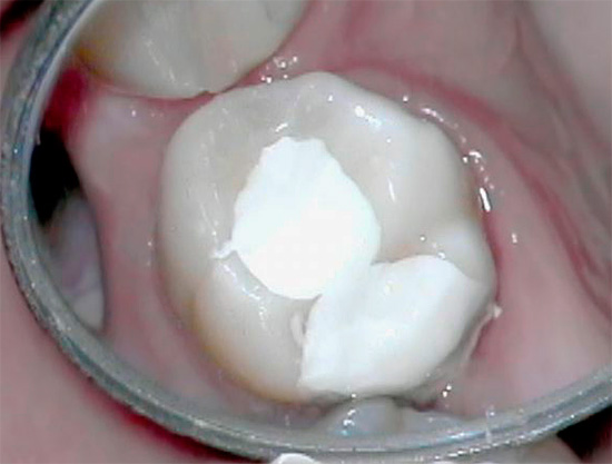 La colocación de una pasta desvitalizante en un diente y el posterior cierre hermético de la cavidad con un relleno temporal en la pulpitis gangrenosa crónica no siempre está justificada.