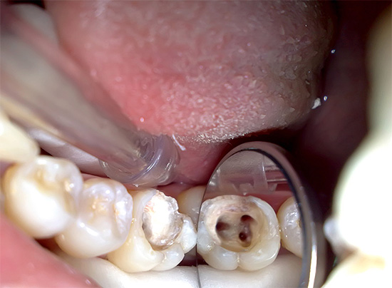 Снимката ясно показва устието на кореновите канали на зъба.