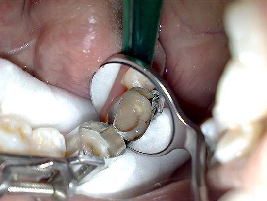 Entonces comienza la restauración de los tejidos perdidos por el diente.