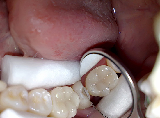 Y así es como se ve el diente al final del tratamiento de la pulpitis, que no debe distinguirse de la vida.
