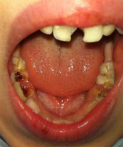 El tratamiento de la pulpitis gangrenosa crónica en niños a veces puede tener sus propias características ...