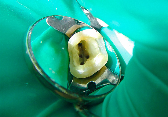 Mientras más canales radiculares en un diente, más costoso es el tratamiento de la pulpitis.