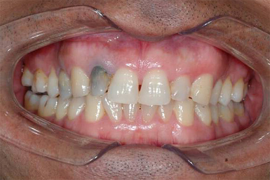 Сивият нюанс на зъба, показан на снимката, може да показва хроничен гангренозен пулпит.