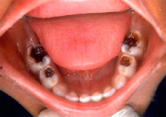 A veces, varios dientes se ven afectados por la pulpitis gangrenosa crónica, que es especialmente característica de los niños.