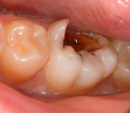 Характерна особеност на хроничния пулпит е леки симптоми, които често водят до твърде късно лечение на стоматологичната помощ ...