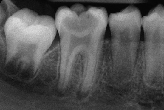 Радиографските изображения могат да разкрият скрити патологии в зъба и околните му тъкани, както и да оценят дължината и формата на кореновите канали.
