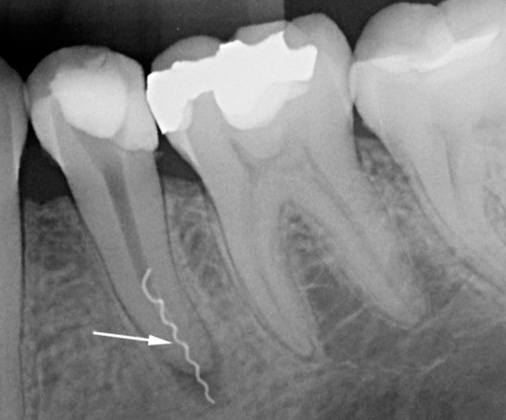 Рентгеновият лъч ясно показва счупения край на инструмента в корена на зъба.