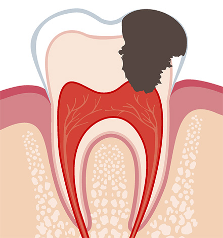 La pulpitis se desarrolla cuando la infección llega al nervio del diente, causando que se inflame.