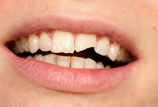 Cuando el daño mecánico a los dientes puede desarrollar pulpitis traumática.