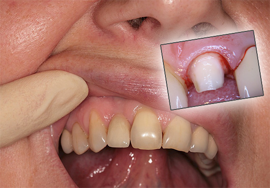 Hãy xem tại sao đôi khi một chiếc răng bị đau dưới vương miện và những gì có thể được thực hiện trong những trường hợp như vậy để giảm bớt sự đau khổ ...