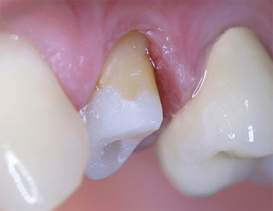 Chaque couronne est caractérisée par une certaine durée de vie, après quoi la dent en dessous risque de tomber malade.