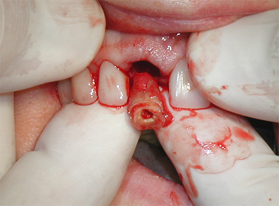 Sometimes the doctor decides to remove a tooth if protection by its crown is no longer possible and expedient.