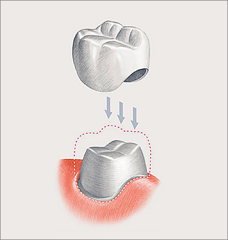 De afbeelding toont een schema van een klassieke tandheelkundige kroon.