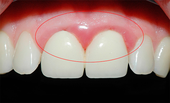 Manchmal kann eine falsch installierte Krone das Zahnfleisch verletzen, wodurch sich eine Entzündung entwickelt ...