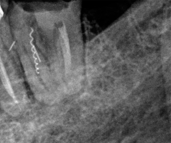 Ένα άλλο πλάνο που δείχνει σαφώς ένα κομμάτι οδοντιατρικού οργάνου κολλημένο στο κανάλι.