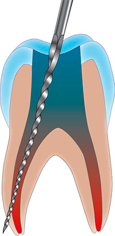 Una causa común de dolor posterior al llenado en el diente en el que se extrae el nervio es la perforación de la pared del conducto radicular.